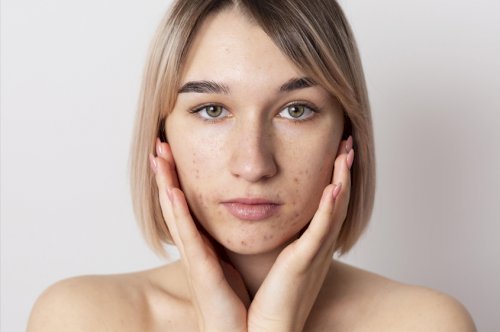 Understanding Skin Pigmentation and Effective Solutions to Tackle Pigmentation