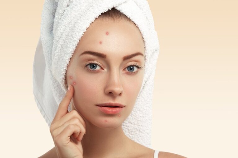 Wonderful Tips To Deal With Pigmentation In Upcoming Winters